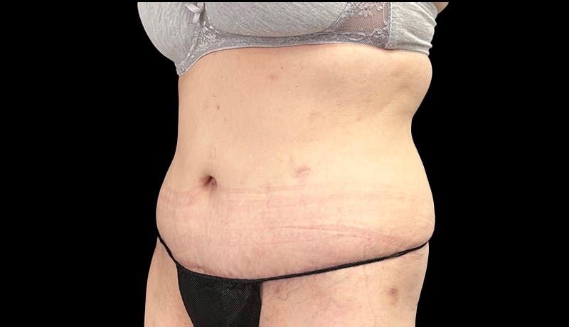 Abdominoplasty Before & After Gallery - Patient 148678281 - Image 8