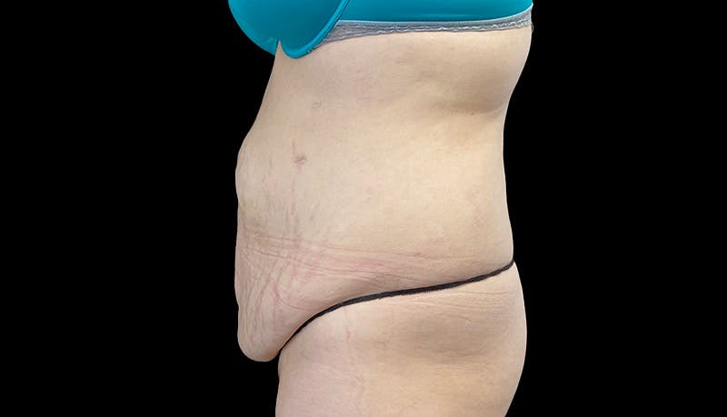 Abdominoplasty Before & After Gallery - Patient 148678281 - Image 9