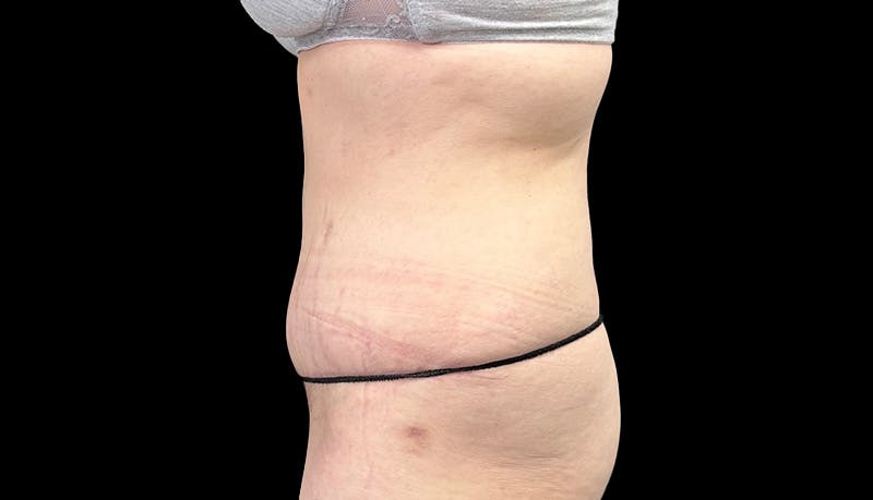 Abdominoplasty Before & After Gallery - Patient 148678281 - Image 10