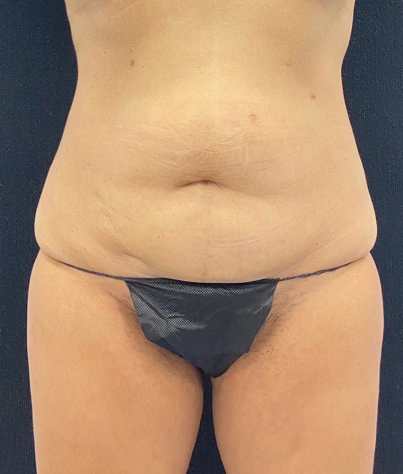 Lower Body Lift Before & After Gallery - Patient 148864468 - Image 1