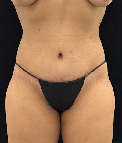 Lower Body Lift Before & After Gallery - Patient 148864468 - Image 2