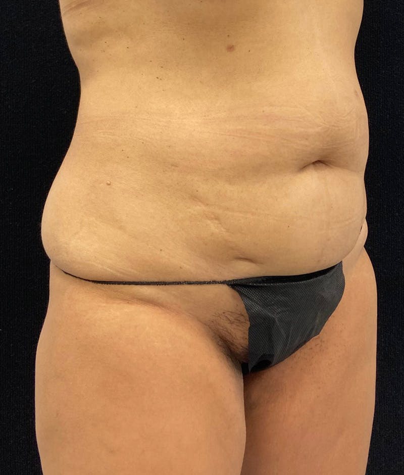 Lower Body Lift Before & After Gallery - Patient 148864468 - Image 3