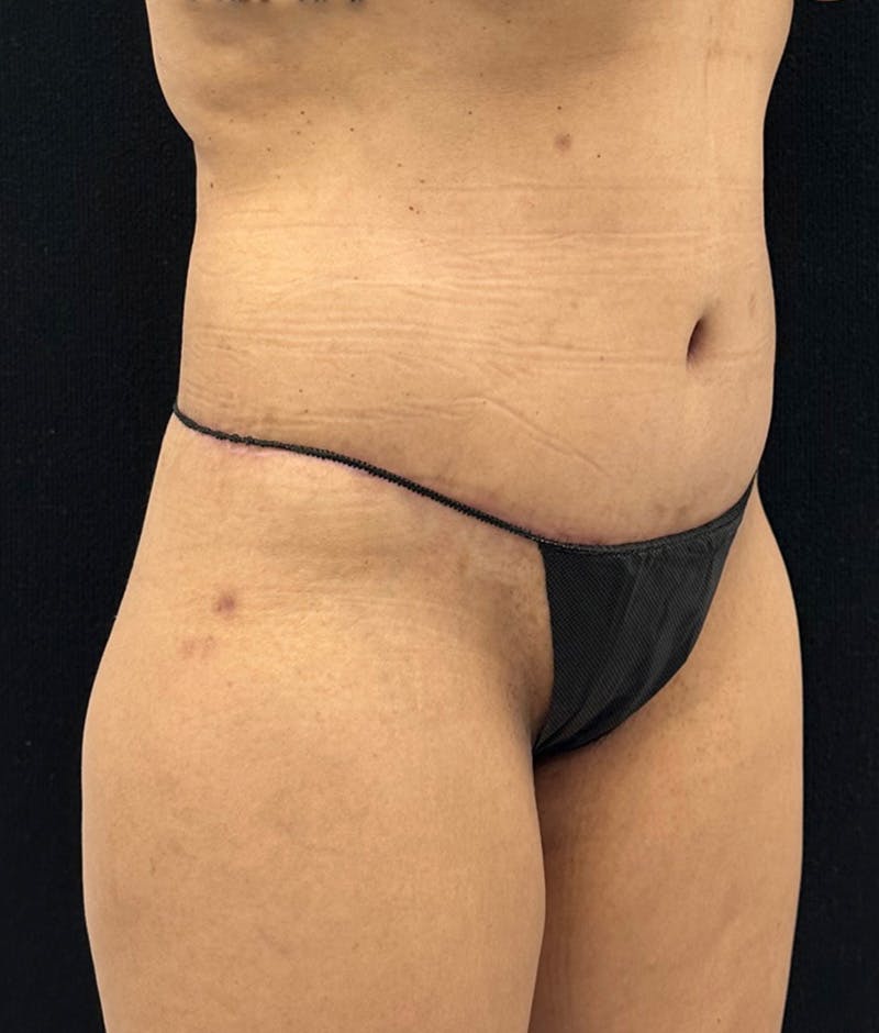 Lower Body Lift Before & After Gallery - Patient 148864468 - Image 4