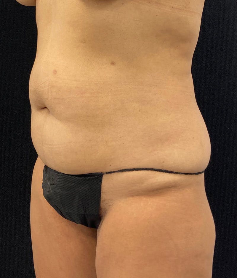 Lower Body Lift Before & After Gallery - Patient 148864468 - Image 7