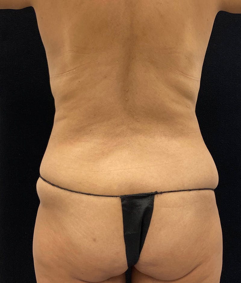 Lower Body Lift Before & After Gallery - Patient 148864468 - Image 11