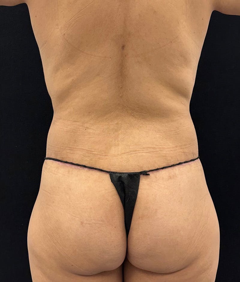 Lower Body Lift Before & After Gallery - Patient 148864468 - Image 12