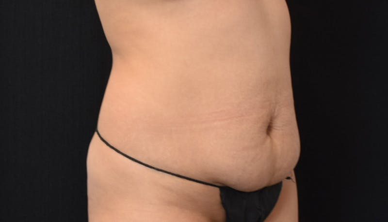 Abdominoplasty Before & After Gallery - Patient 148992014 - Image 3