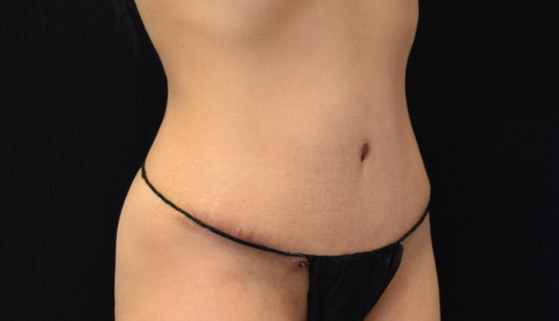 Abdominoplasty Before & After Gallery - Patient 148992014 - Image 4