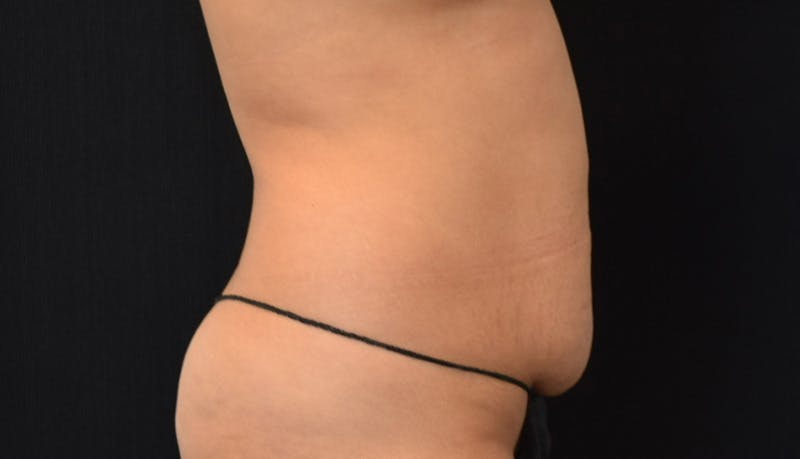 Abdominoplasty Before & After Gallery - Patient 148992014 - Image 5