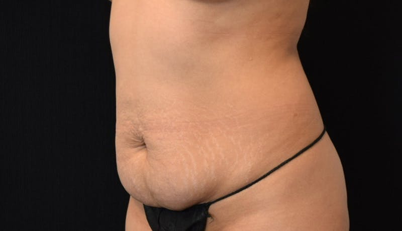 Abdominoplasty Before & After Gallery - Patient 148992014 - Image 7