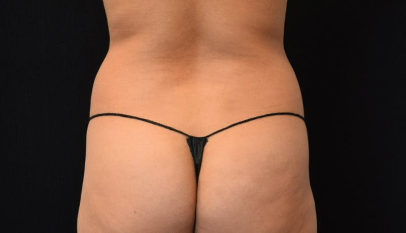 Abdominoplasty Before & After Gallery - Patient 148992014 - Image 11