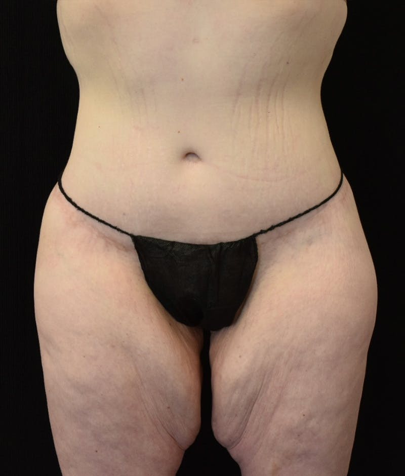 Lower Body Lift Before & After Gallery - Patient 149096973 - Image 2