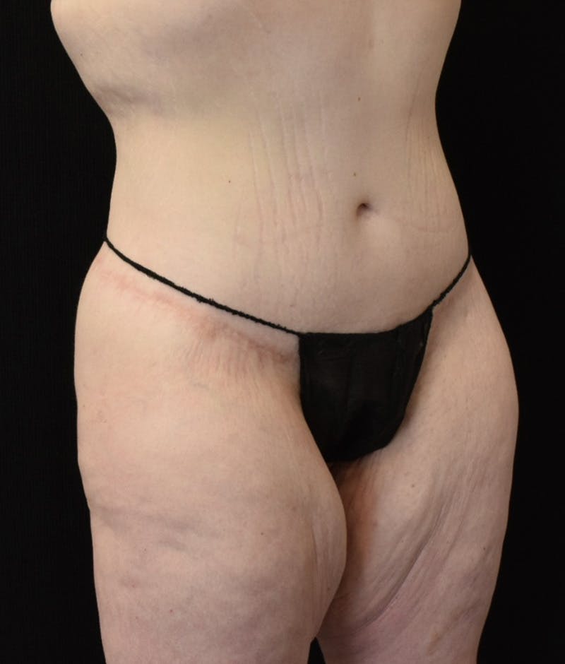 Lower Body Lift Before & After Gallery - Patient 149096973 - Image 4