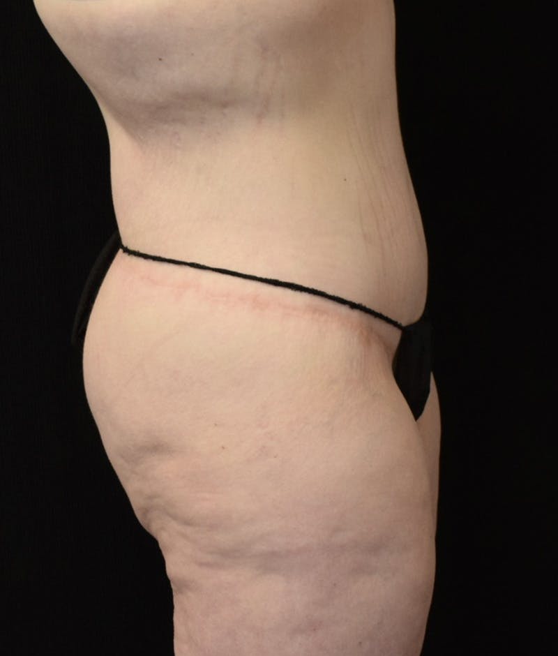 Lower Body Lift Before & After Gallery - Patient 149096973 - Image 6