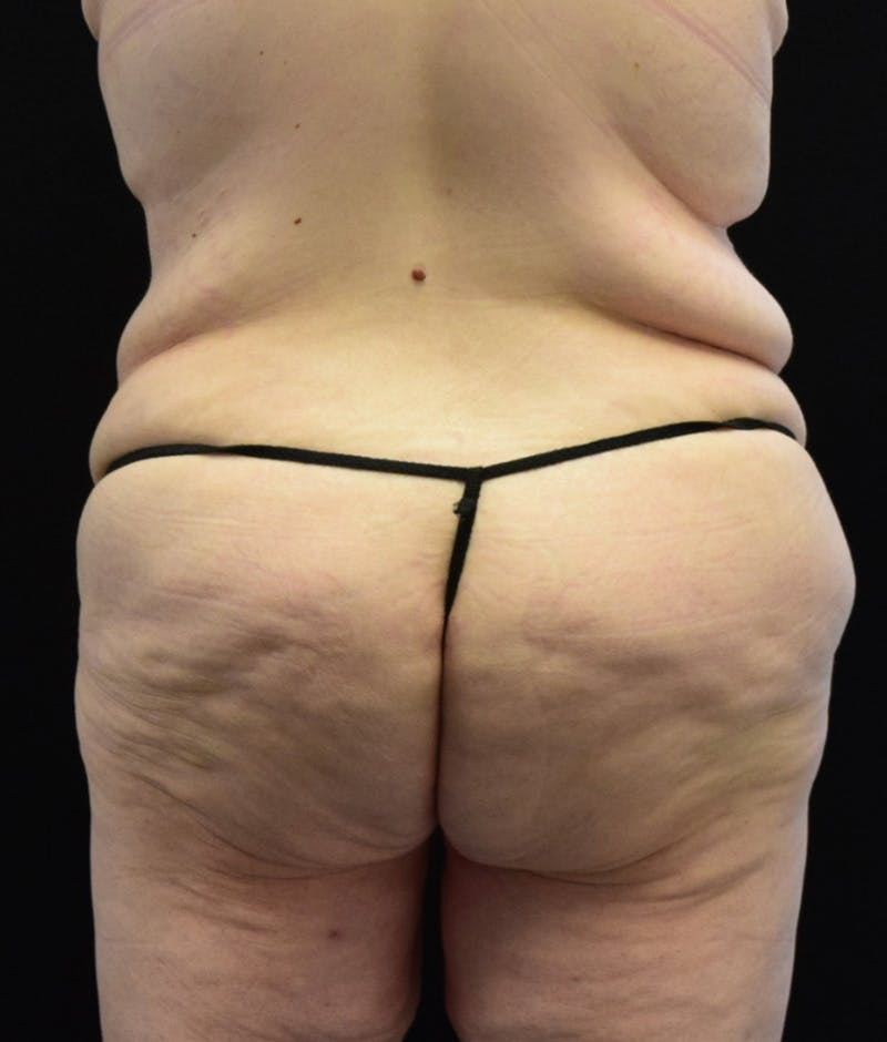 Lower Body Lift Before & After Gallery - Patient 149096973 - Image 7