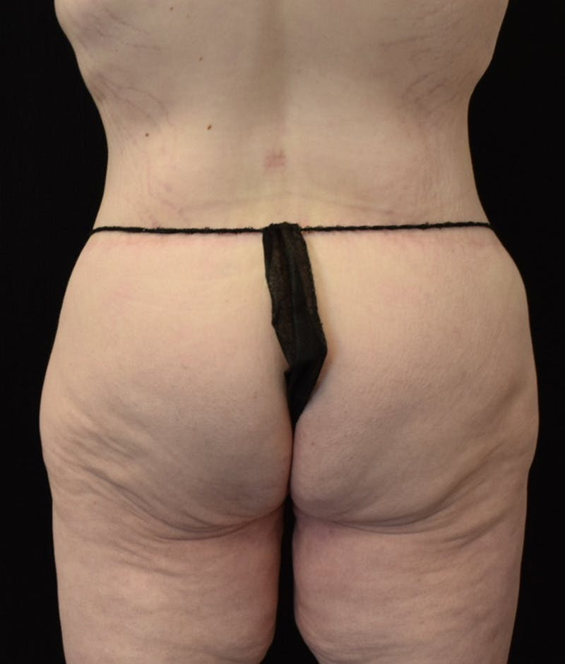 Lower Body Lift Before & After Gallery - Patient 149096973 - Image 8