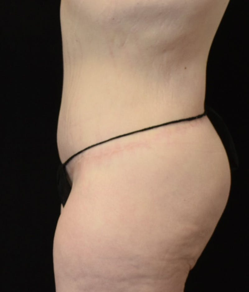 Lower Body Lift Before & After Gallery - Patient 149096973 - Image 12
