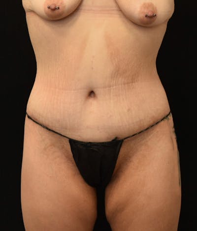 Lower Body Lift Before & After Gallery - Patient 149385888 - Image 2