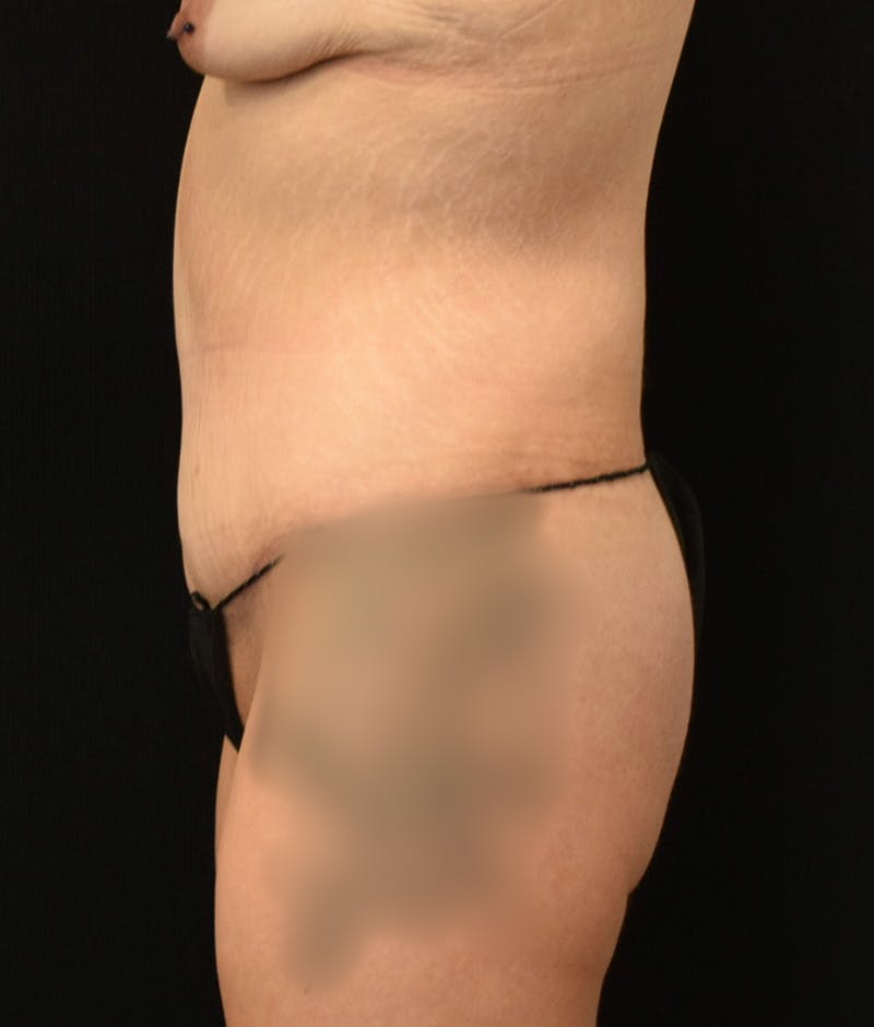 Lower Body Lift Before & After Gallery - Patient 149385888 - Image 10