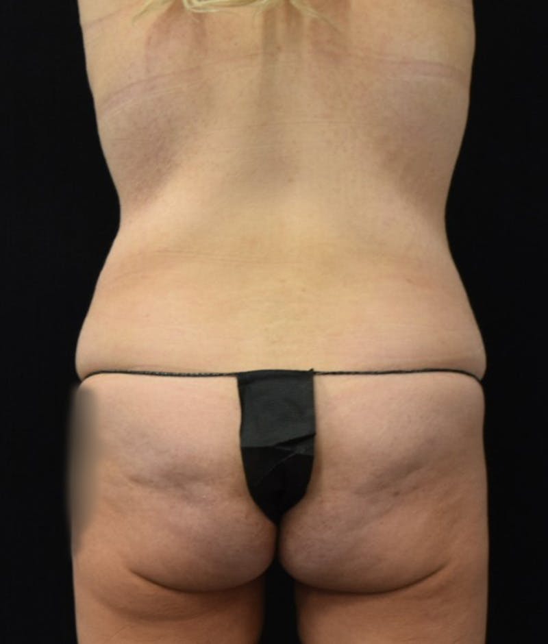 Lower Body Lift Before & After Gallery - Patient 149385888 - Image 11