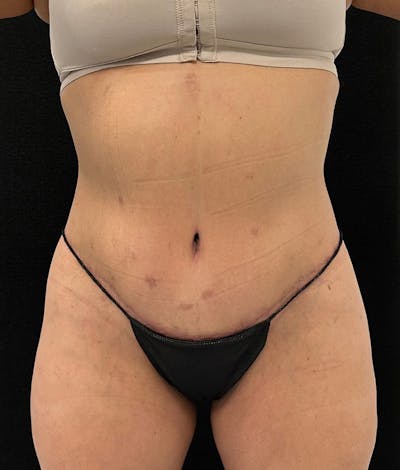 Lower Body Lift Before & After Gallery - Patient 150896030 - Image 2