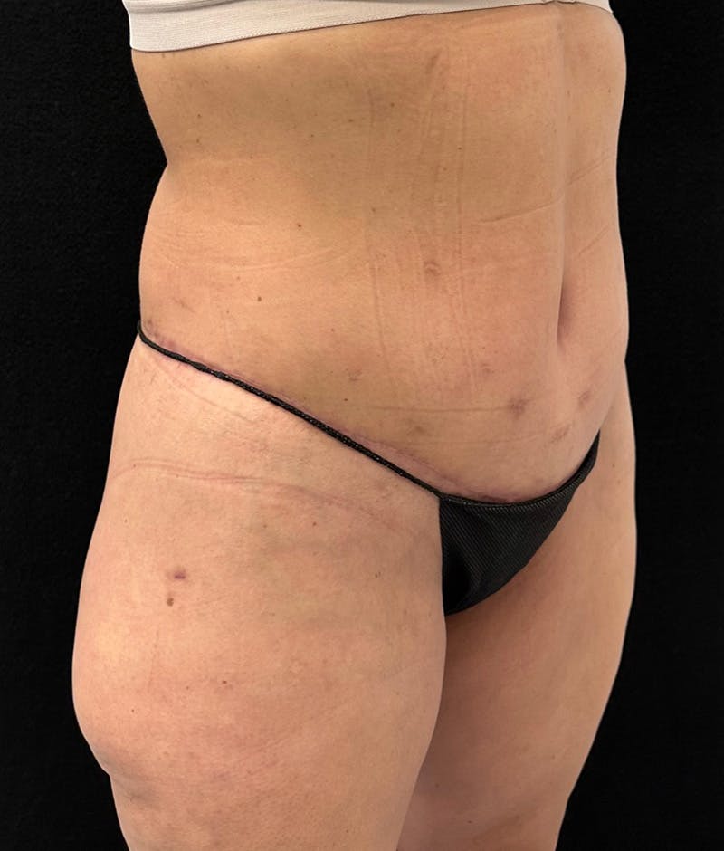 Lower Body Lift Before & After Gallery - Patient 150896030 - Image 4