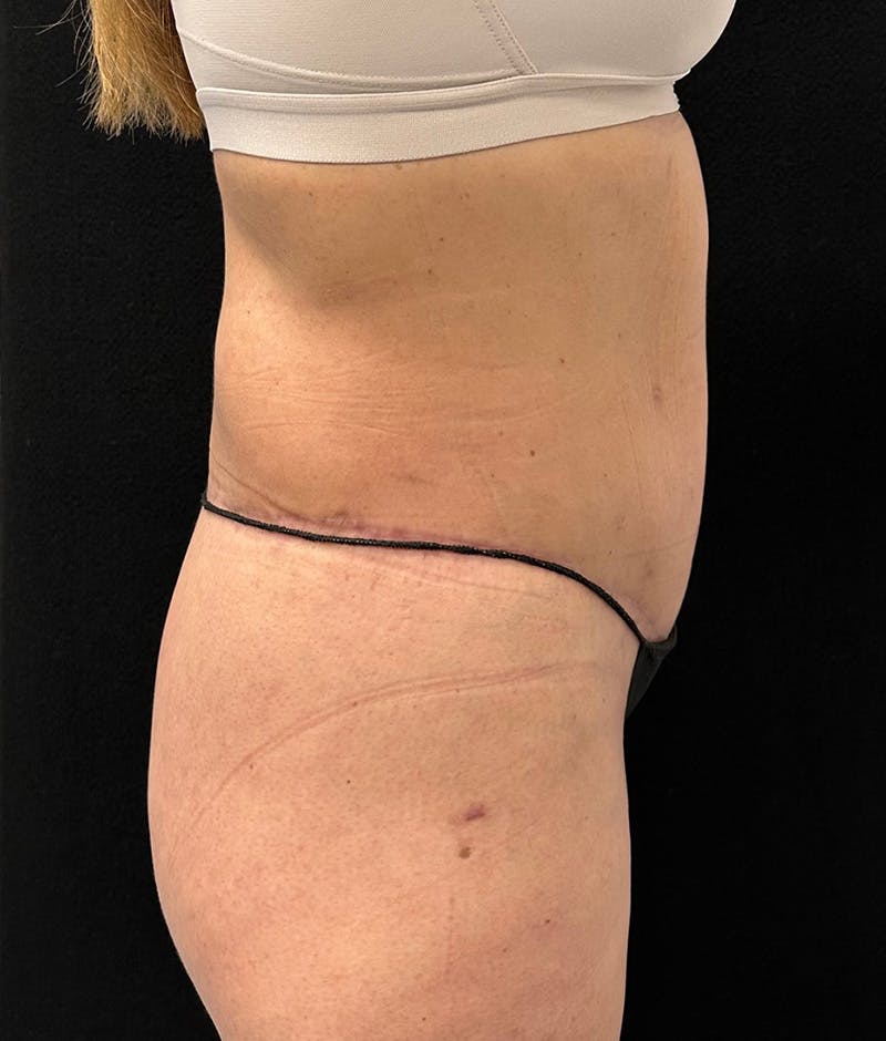 Lower Body Lift Before & After Gallery - Patient 150896030 - Image 6