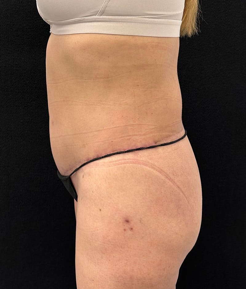 Lower Body Lift Before & After Gallery - Patient 150896030 - Image 10