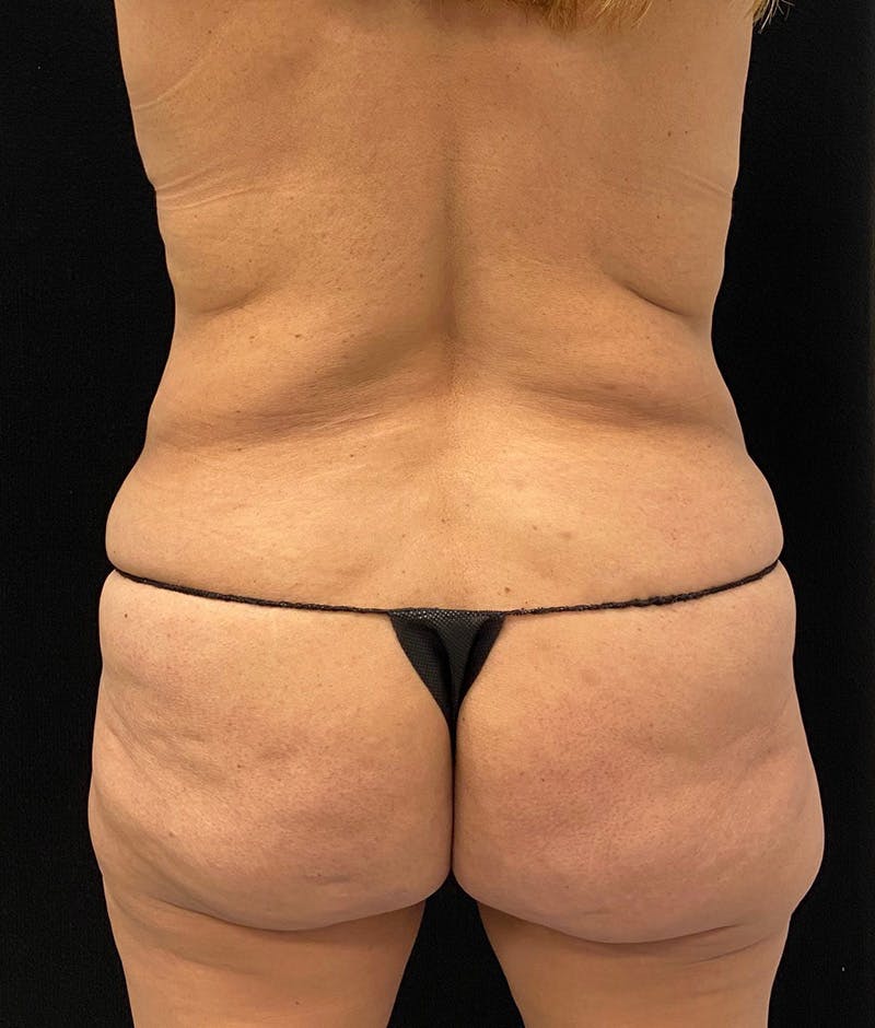 Lower Body Lift Before & After Gallery - Patient 150896030 - Image 11