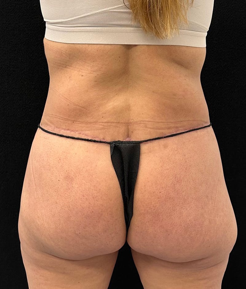 Lower Body Lift Before & After Gallery - Patient 150896030 - Image 12