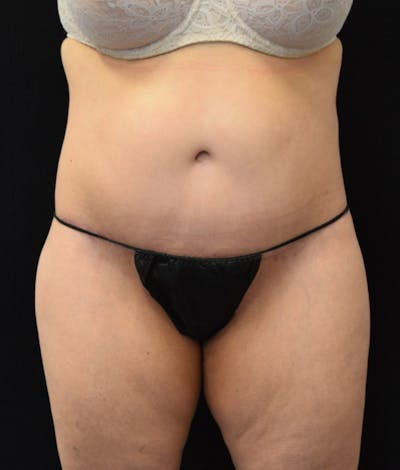 Lower Body Lift Before & After Gallery - Patient 154785656 - Image 2