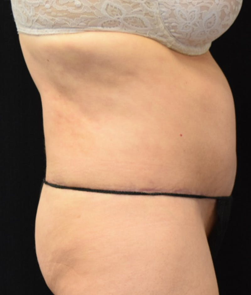 Lower Body Lift Before & After Gallery - Patient 154785656 - Image 6