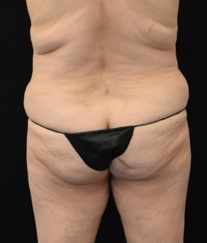 Lower Body Lift Before & After Gallery - Patient 154785656 - Image 11