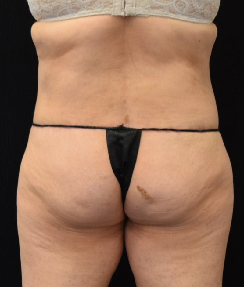 Lower Body Lift Before & After Gallery - Patient 154785656 - Image 12
