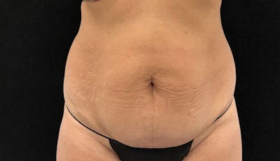 Abdominoplasty Before & After Gallery - Patient 163002426 - Image 1