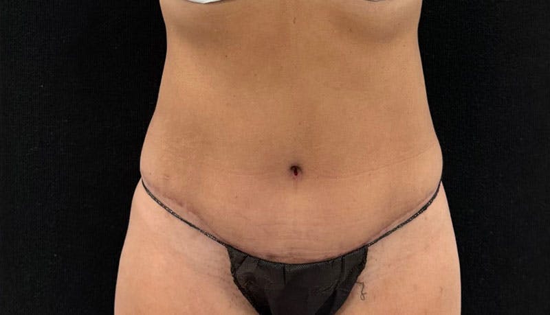Abdominoplasty Before & After Gallery - Patient 163002426 - Image 2
