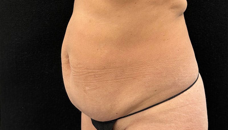 Abdominoplasty Before & After Gallery - Patient 163002426 - Image 3