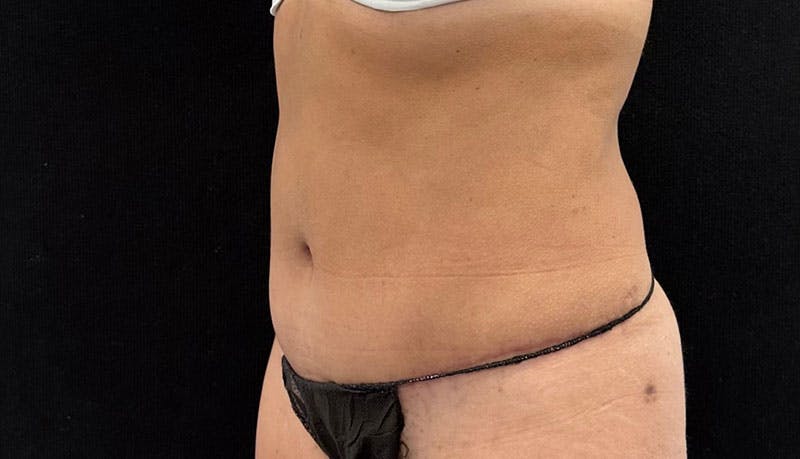 Abdominoplasty Before & After Gallery - Patient 163002426 - Image 4