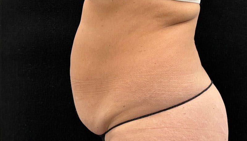 Abdominoplasty Before & After Gallery - Patient 163002426 - Image 5