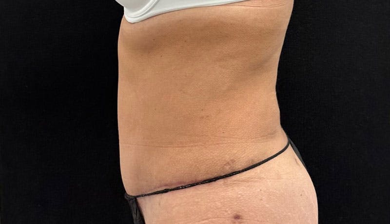 Abdominoplasty Before & After Gallery - Patient 163002426 - Image 6