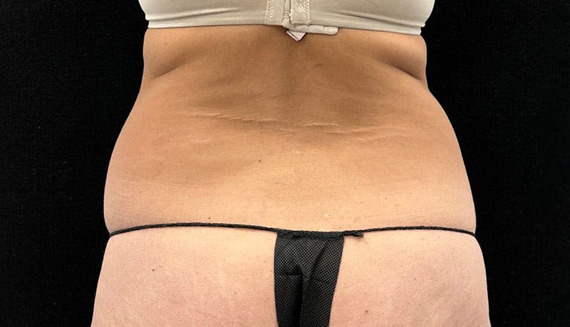 Abdominoplasty Before & After Gallery - Patient 163002426 - Image 7