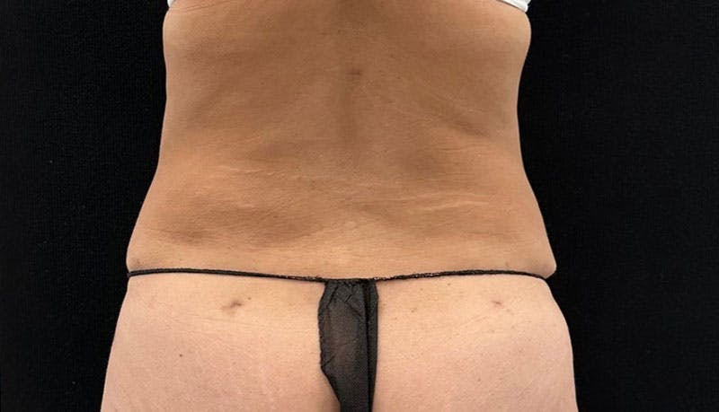 Abdominoplasty Before & After Gallery - Patient 163002426 - Image 8