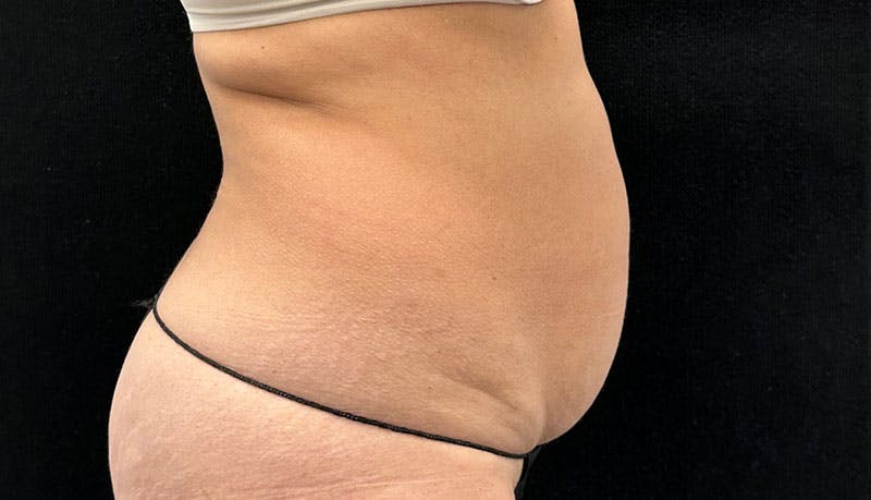 Abdominoplasty Before & After Gallery - Patient 163002426 - Image 9