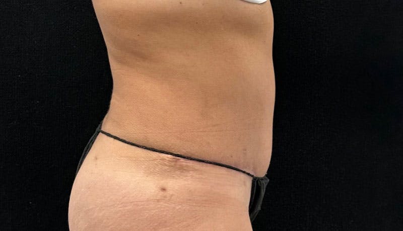 Abdominoplasty Before & After Gallery - Patient 163002426 - Image 10