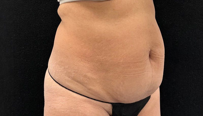 Abdominoplasty Before & After Gallery - Patient 163002426 - Image 11