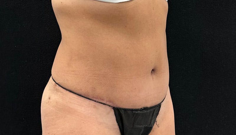 Abdominoplasty Before & After Gallery - Patient 163002426 - Image 12