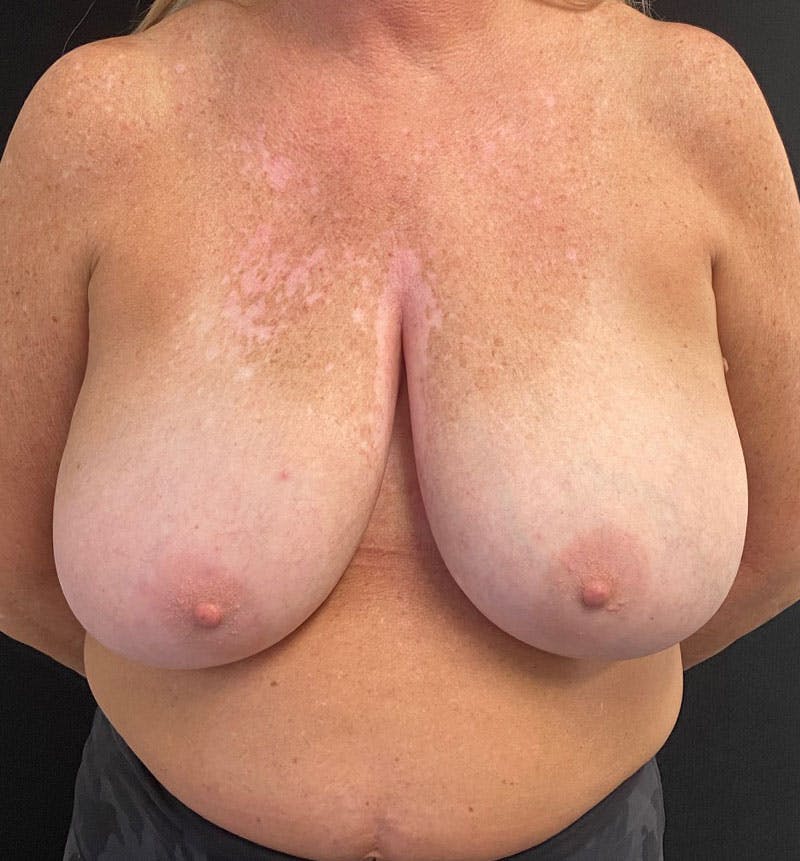 Breast Reduction Before & After Gallery - Patient 163002805 - Image 1