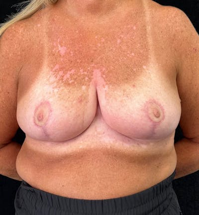 Breast Reduction Before & After Gallery - Patient 163002805 - Image 2