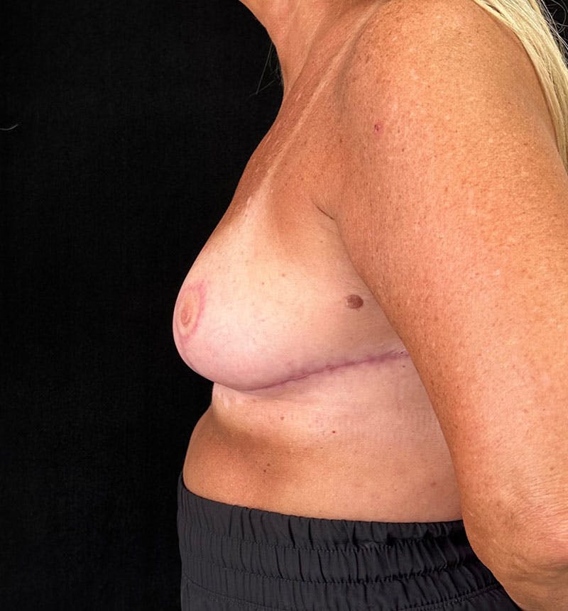 Breast Reduction Before & After Gallery - Patient 163002805 - Image 6
