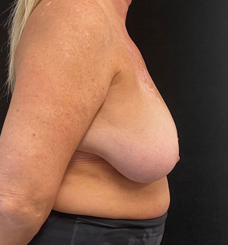 Breast Reduction Before & After Gallery - Patient 163002805 - Image 7